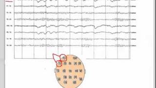 EEG  101 [upl. by Eillak385]