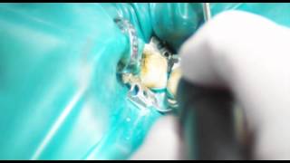 Endodontische Keimreduktion [upl. by Ecineg932]