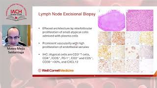 Not all Paraproteinemia is Myeloma [upl. by Kwang]