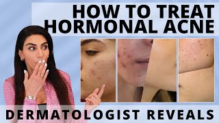 Dermatologist Unveils How to Treat Hormonal Acne  acne acnetreatment hormonalacne [upl. by Borszcz184]