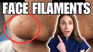 Sebaceous Filaments Vs Demodex Face Mites [upl. by Atiuqcaj]