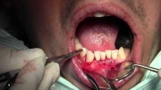 Alloderm Gingival Grafting 262524 Sling Suturing of Native Tissues [upl. by Namus5]