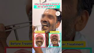 Mouth Opening Exercises for Cancer Patients  Cancer Trismus care shorts mouthcancertreatment [upl. by Beckerman176]