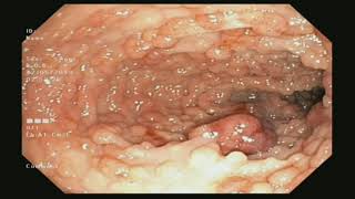 Familial Adenomatous Polyposis Coli FAP found during Colonoscopy [upl. by Asserac]