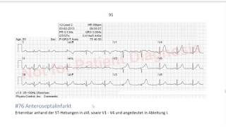 EKG in 3 Minuten 8 [upl. by Novelc]