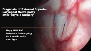 Diagnosis of External Superior Laryngeal Nerve palsy after Thyroid Surgery [upl. by Jabez]