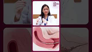 Embryo transfer in IVF treatment  Dr Manisha Jain  IVF Specialist  Nova IVF Chandigarh [upl. by Claudina]