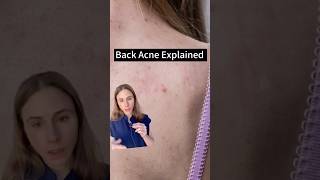 Uncovering The Truth About Back Acne [upl. by Johnna775]