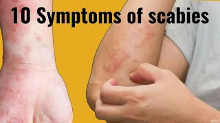 Symptoms of scabies [upl. by Eseerehs]