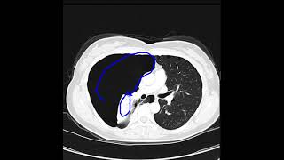 Pneumothorax due to lymphangioleiomyomatosis [upl. by Leahcimsemaj]