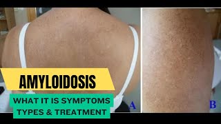 Amyloidosis What It Is Symptoms Types amp Treatment [upl. by Esojnauj]