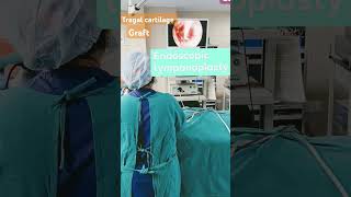 एंडोस्कोपिक टिम्पेनोप्लास्ट ENDOSCOPIC TYMPANOPLASTY endoscopicearsurgerytympanoplastyyoutube [upl. by Mak980]