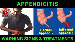 Appendicitis Symptoms and Treatment Options appendicitis [upl. by Ekaterina]