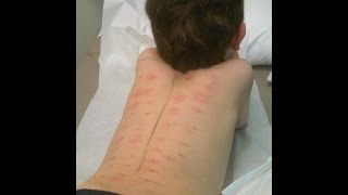 Food Allergy Testing [upl. by Wyne825]