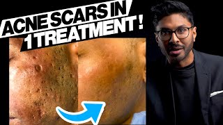 How To Get Rid Of Acne Scars In One Go [upl. by Kinchen686]