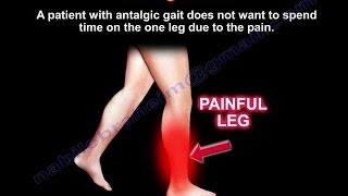 Antalgic Gait  Everything You Need To Know  Dr Nabil Ebraheim [upl. by Naitirb]