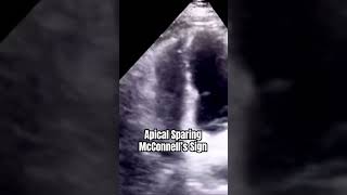 McConnell’s Sign echocardiography [upl. by Eybbob899]