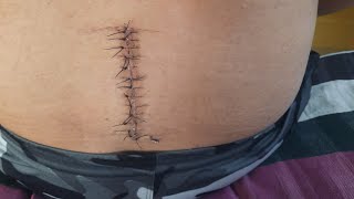 After back surgery L4 L5S1 Disc bulgeDisc decompressionlower back surgery Disc Break after surgery [upl. by Sophia]