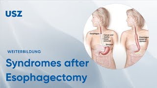 Functional syndromes after Esophagectomy – Please participate in our 3minute survey below [upl. by Nydia165]