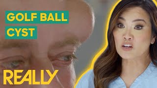 Dr Lee Removes 16YearOld GOLF BALLSized Cyst  Dr Pimple Popper [upl. by Hillari]