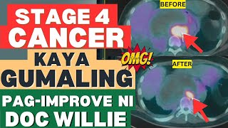 Stage 4 Cancer Kaya Pa Gumaling By Doc Willie Ong [upl. by Koziel781]