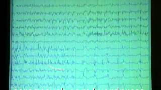 Long term monitored EEG [upl. by Acus]