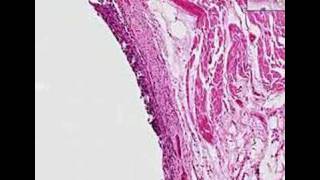 Histopathology Lung Squamous cell carcinoma [upl. by Nipsirc546]