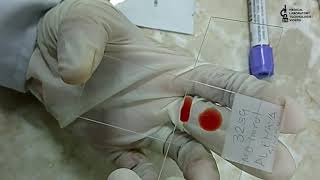 Blood smear preparation2 methods to learnThick amp Thin smear preparation [upl. by Akira]