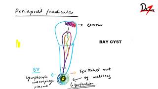 Radicular cyst  PATHOGENESIS CF RF amp TREATMENT [upl. by Ettenoj]