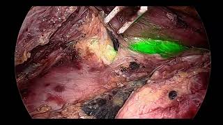 Fluorescence guided esophagectomy  Left bronchial dissection [upl. by Celle]