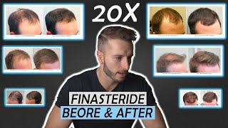 20 Finasteride Before And After Results NW1  NW5NW6 [upl. by Havener]