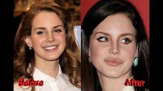 Lana Del Rey Plastic Surgery Before and After Lip Implants and Nose Job [upl. by Ajim]