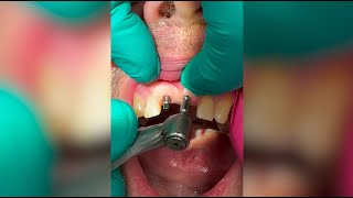 Monday Morning Minute  🎥 Get a Chairside View of Dr Shatkins Latest Mono Implant Case 🦷 [upl. by Etteval]