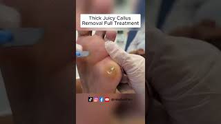 Ultimate Callus Removal Full Treatment For Smooth Feet  FootClinicLondoncouk [upl. by Norud]