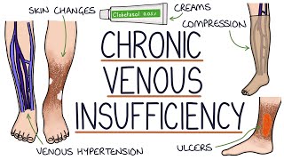 Understanding Chronic Venous Insufficiency [upl. by Onairpic]