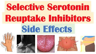 SSRI Antidepressant Side Effects amp Why They Occur  Fluoxetine Paroxetine Sertraline Citalopram [upl. by September]