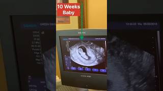 10 Week Baby 😱😱  USG  Bsc Nursing Students life youtubeshorts trendingshorts ytshorts shorts [upl. by Dallas915]