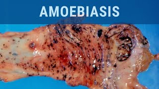 Amoebiasis  Pathology mini tutorial [upl. by Aleacim468]