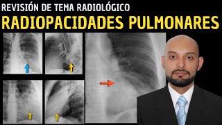 Revisión de Tema 88 Radiopacidades pulmonares [upl. by Tiphane]