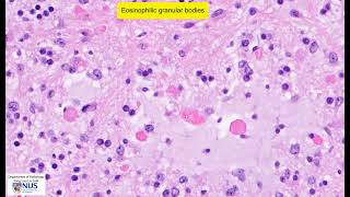 Pilocytic astrocytoma microscopy  Talking slide [upl. by Nosauq]