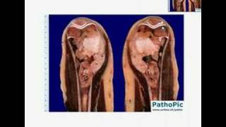 Histopathology BoneOsteosarcoma [upl. by Lubin]