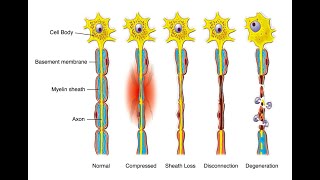 Degrees 1 2 3 4 5 of Nerve injury  Axonotmesis and Neurotmesis [upl. by Hauger783]