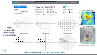 How to interpret the results of an Eyeonic Online Visual Field Test  Visual Field Test 101 [upl. by Tobe151]