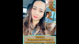 TOTAL THYROIDECTOMY  Multinodular Goitre  Vlog 23 [upl. by Yuh]