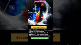 Secondary Tricuspid Regurgitation l TR के कारण echo anatomy shorts [upl. by Kcirej]