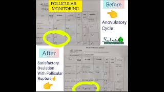 Satisfactory OVULATION STUDY results post Ayurvedic treatment [upl. by Rutra]