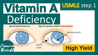 Vitamin A deficiency  xerophthalmia  Keratomalacia  nyctalopia  Phrynoderma  USMLE step1 [upl. by Anilehcim907]