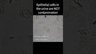 Are epithelial cells in urine contamination [upl. by Ahsocin657]