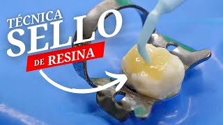 Tecnica de Sello para resina Dental [upl. by Sevik]