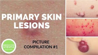 Primary Skin Lesions  Picture Compilation  Medicos Scientia [upl. by Anizor991]